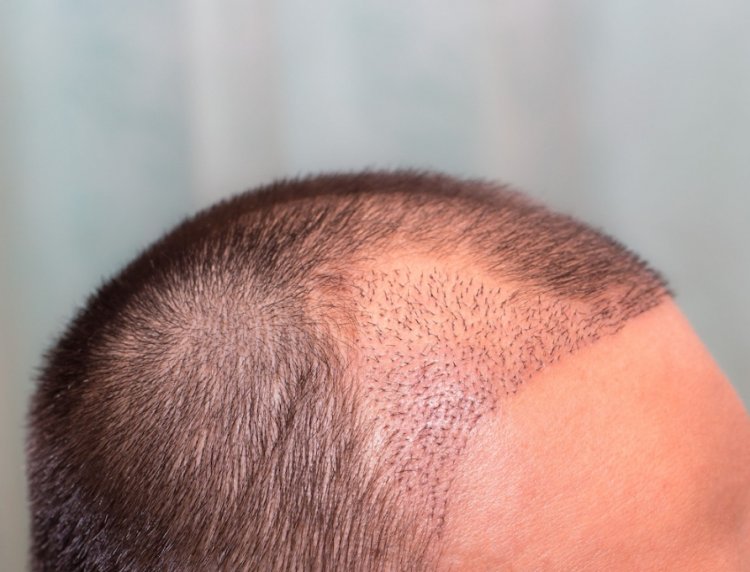 SAĞLIK TURİZMİNDE LİDERLİĞİ BIRAKMIYORUZ!